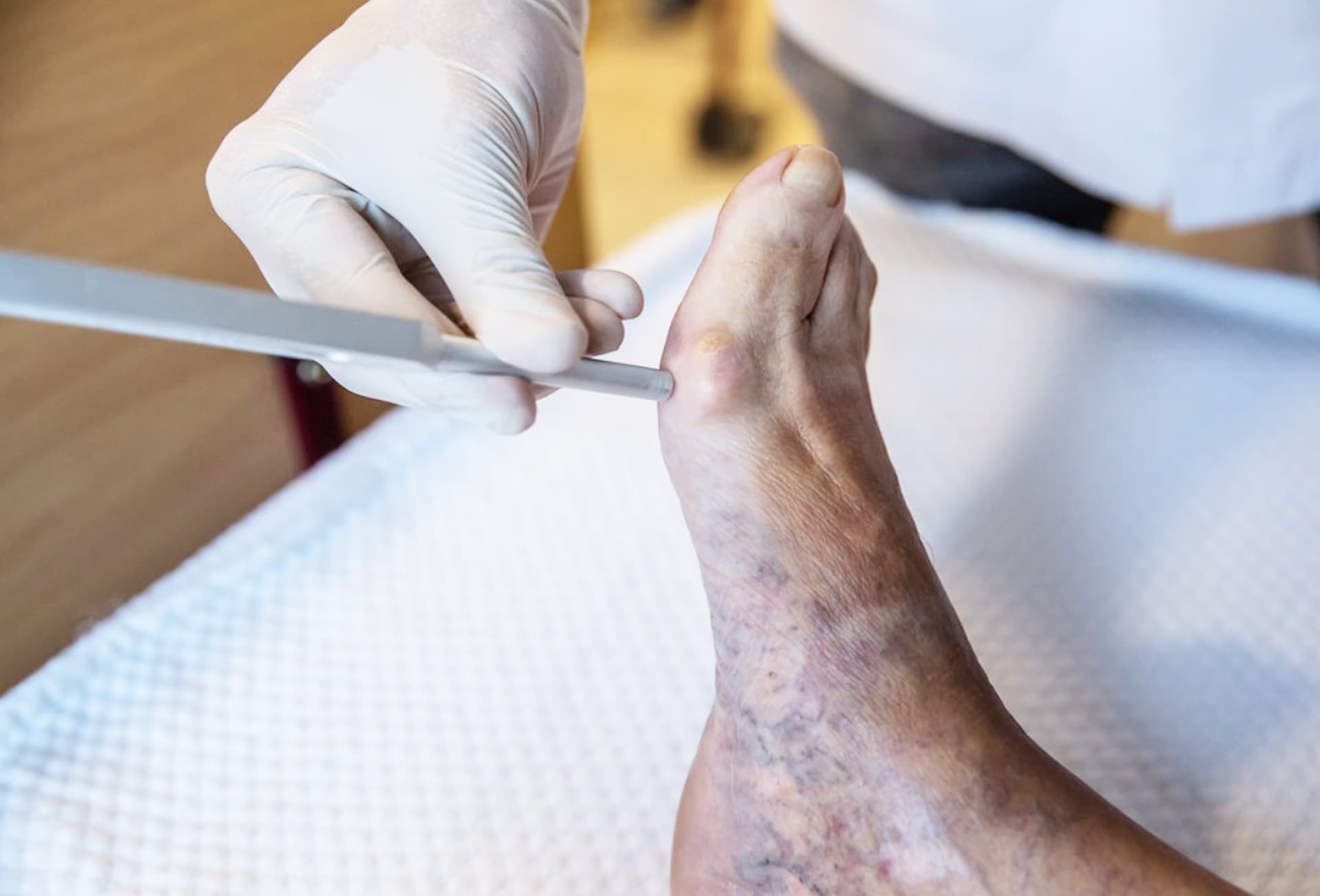 CUIDEN se ocupa del tratamiento del pie diabético en Ourense