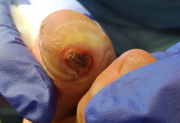  Úlcera isquémica en ourense